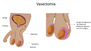 vasectomia_final